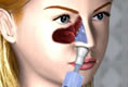 Slowly push the saline solution up into the nostril